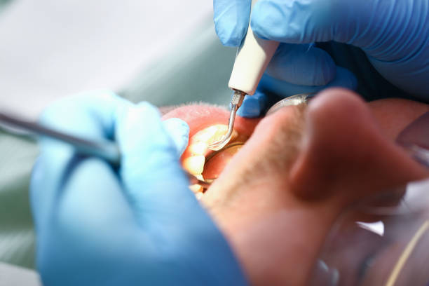 Best Emergency Wisdom Teeth Removal in Tama, IA